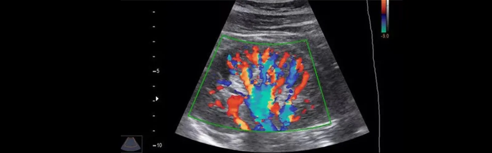 What is the Difference Between Ultrasound and Color Doppler?